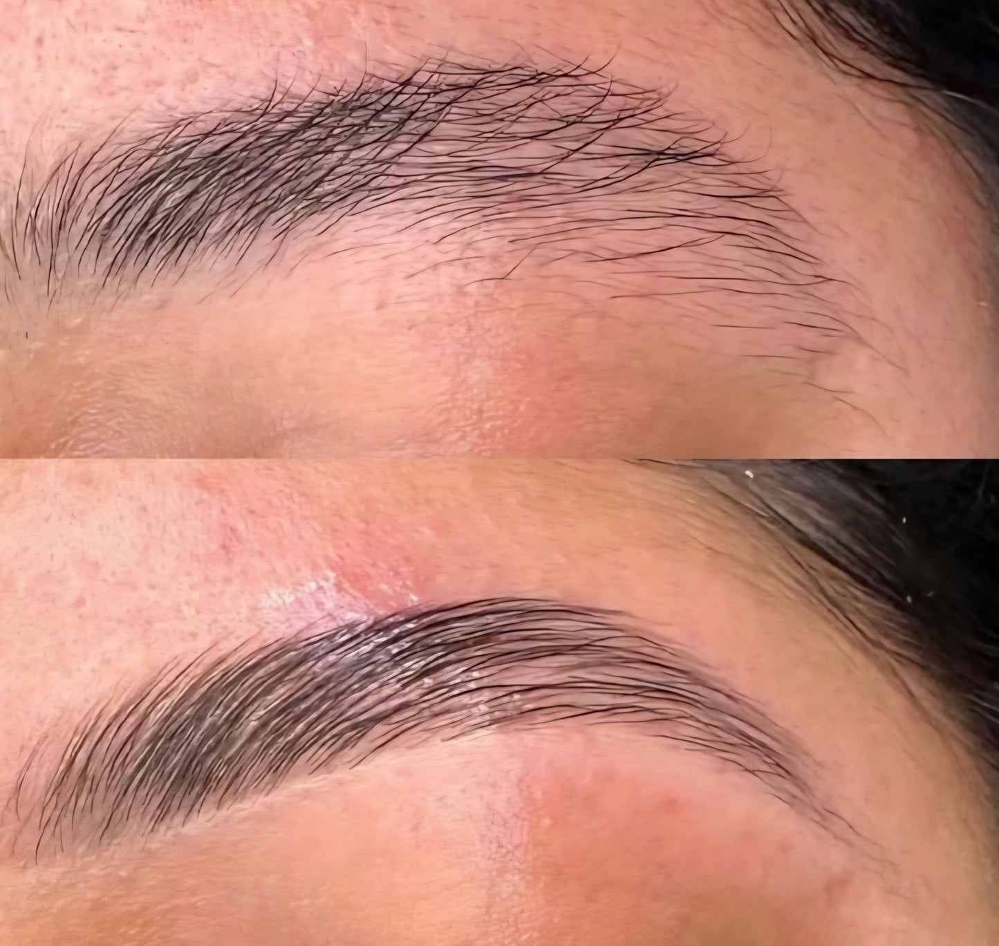Formation browlift